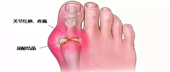 痛風(fēng)一定不要忘了這三個(gè)穴位